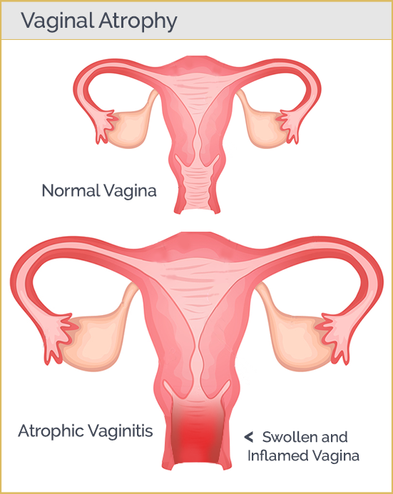 Vaginal Atrophy Star Clinic